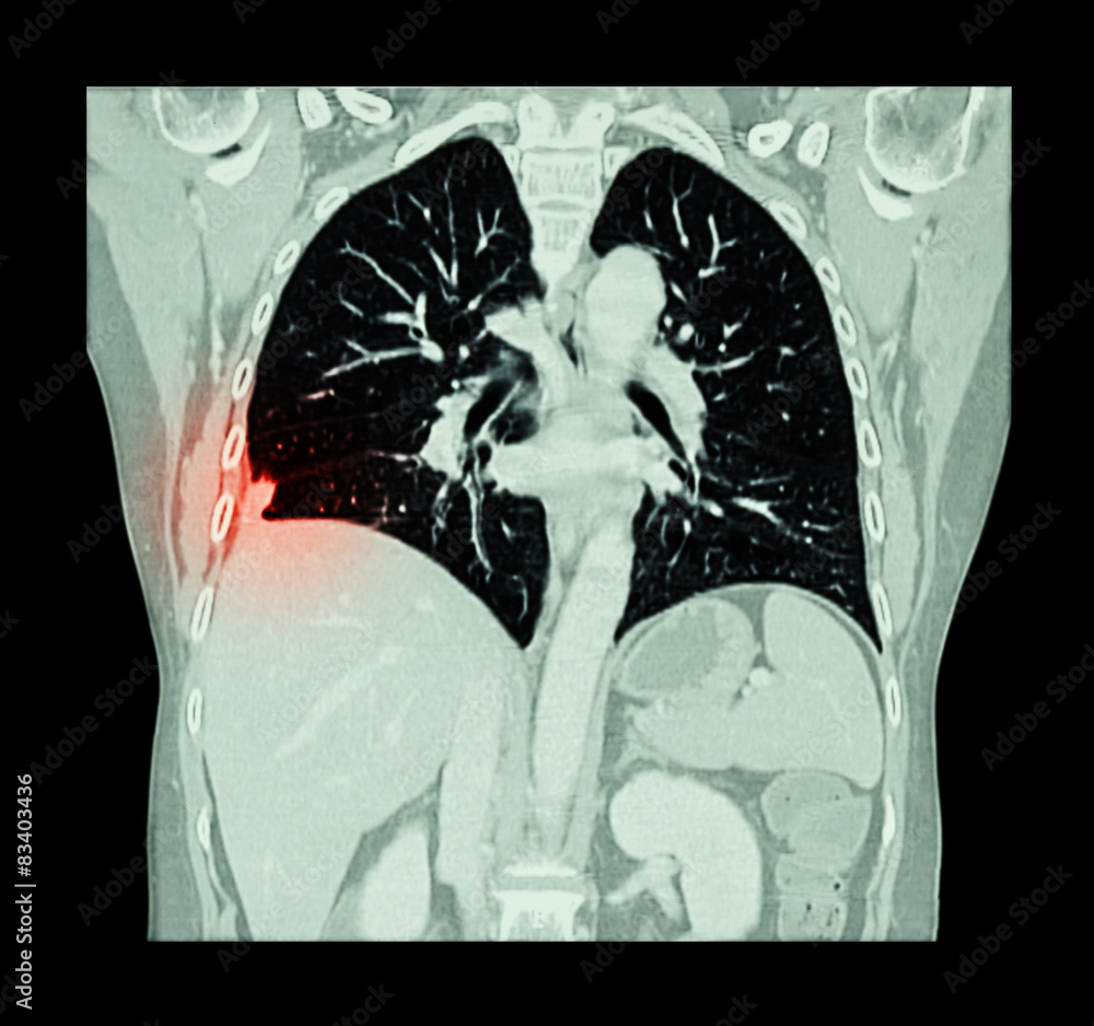 Lung cancer ( CT scan of chest and abdomen : show right lung cancer ...