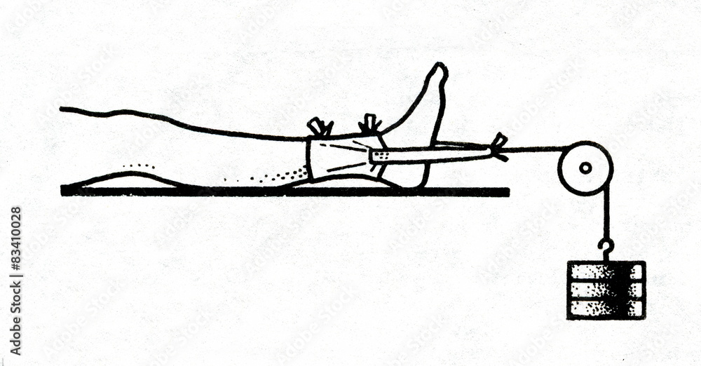 Skin traction of leg fracture Stock Illustration