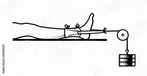 Skin traction of leg fracture