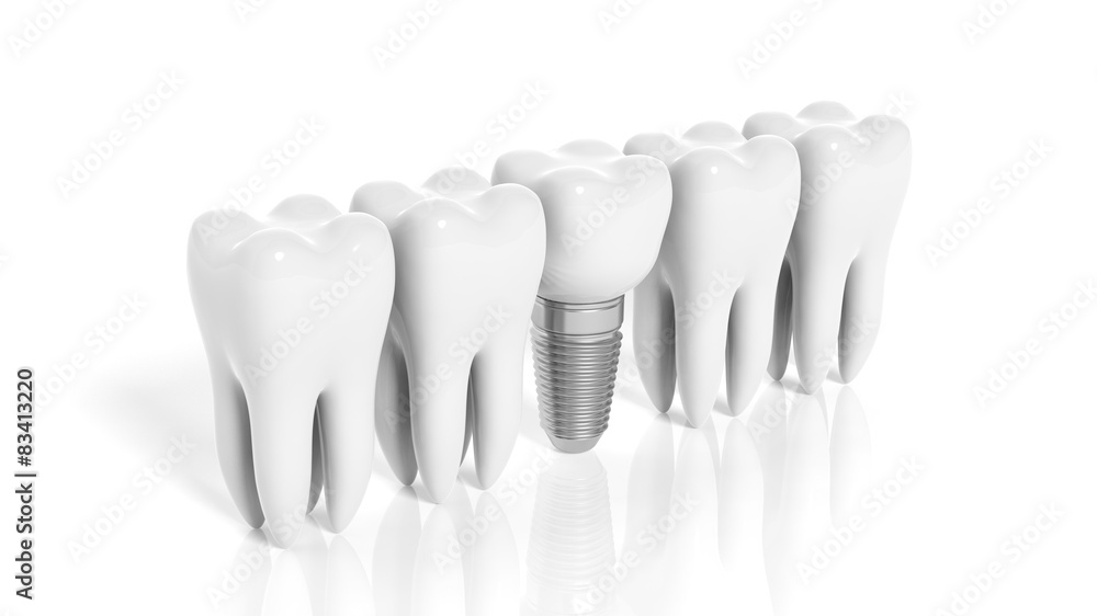 Row of teeth and dental implant isolated on white background Row of teeth and dental implant isolated on white background