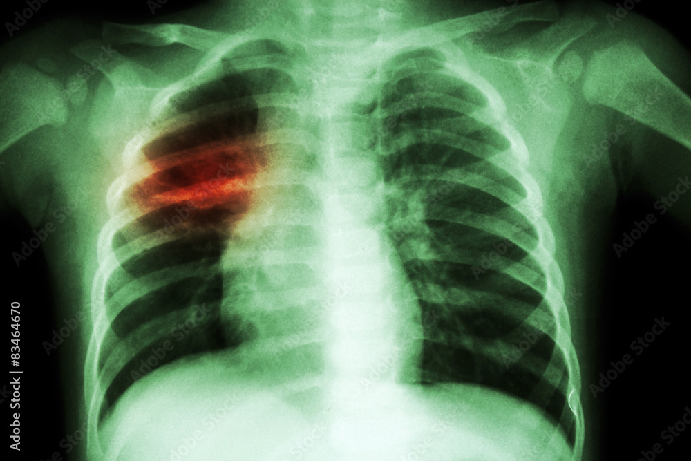 Pulmonary Tuberculosis ( Chest X-ray of child : show patchy infiltration at right middle lung ) Pulmonary Tuberculosis ( Chest X-ray of child : show patchy infiltration at right middle lung )
