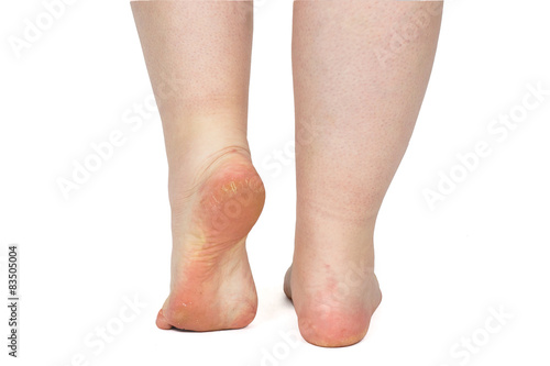 damaged foot problems, neglected. Dermatologist examining a foot for callus and dry skin, towards white