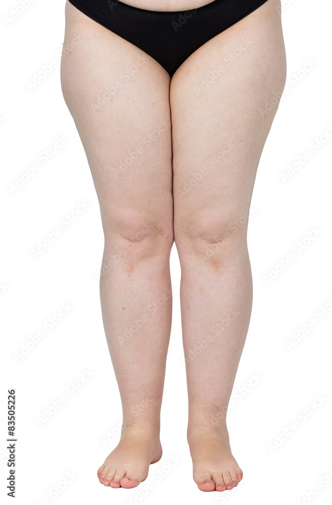 legs obese. Weight problems. trouble walking. płaskosotopie, valgus knee