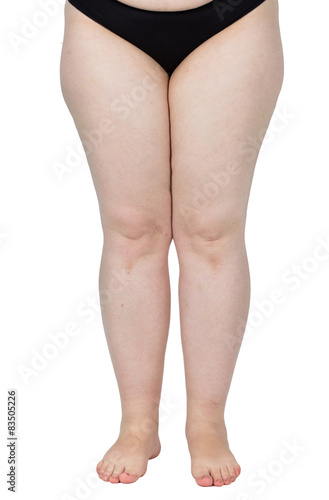 Obraz na płótnie legs obese. Weight problems. trouble walking. płaskosotopie, valgus knee w salonie