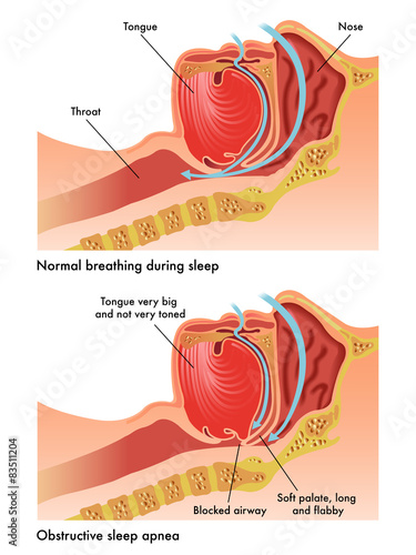 apnea ostruttiva del sonno photo