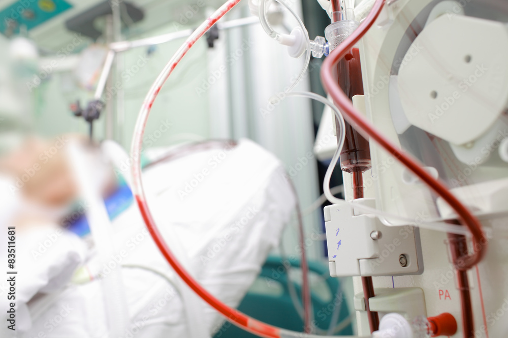 Patient on cardiopulmonary bypass device in the intensive care Patient on cardiopulmonary bypass device in the intensive care