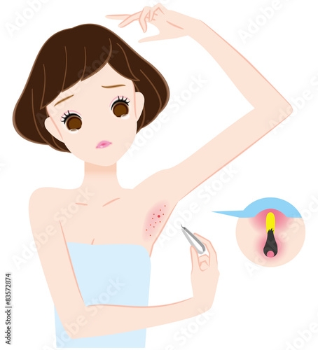 毛抜きで腋毛自己処理して炎症、化膿