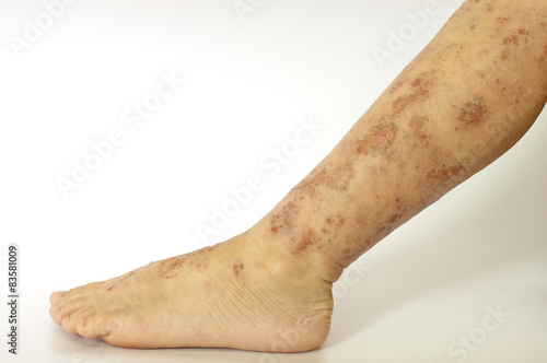 Eczema