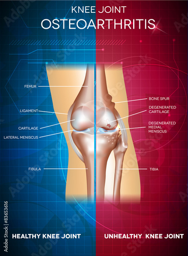 Osteoarthritis