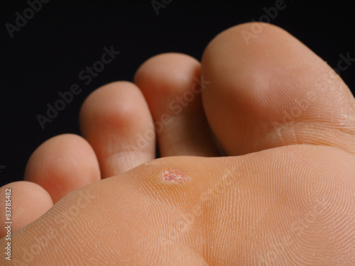 Closeup of foot with a infected wart placed under toes, isolated photo