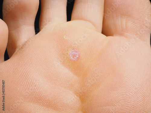 Closeup of foot with a infected wart placed under toes