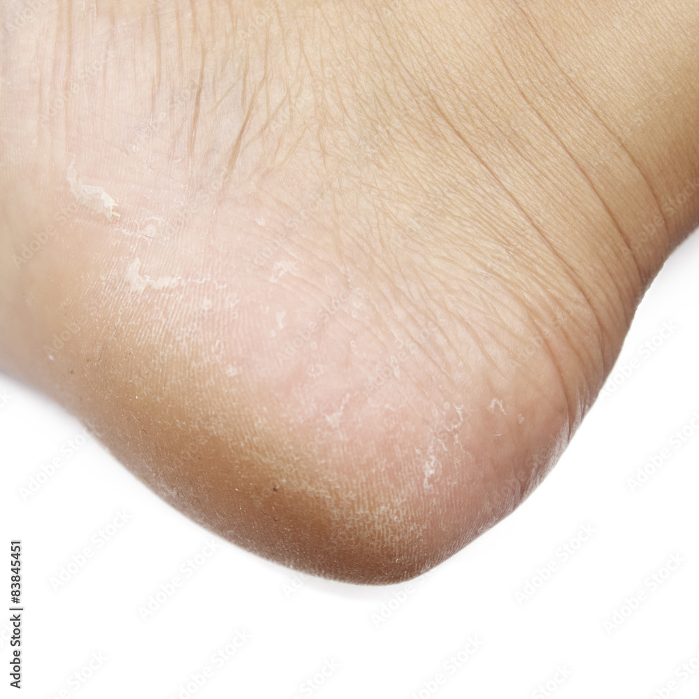 dry skin texture detail of human foot dry skin texture detail of human foot