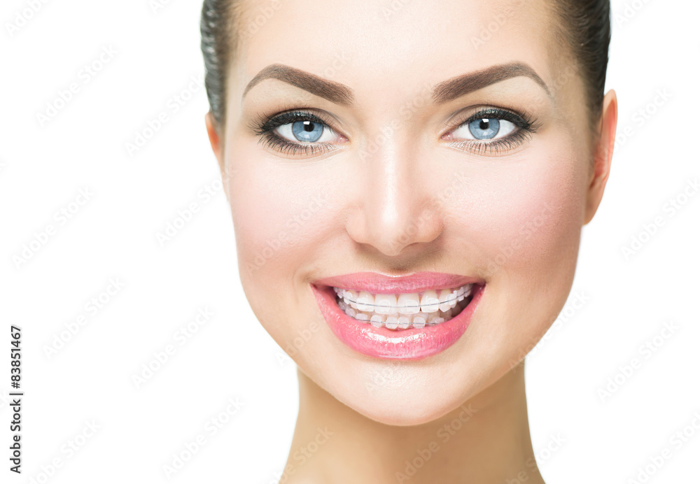 Beautiful woman smiling. Closeup ceramic braces on teeth Beautiful woman smiling. Closeup ceramic braces on teeth