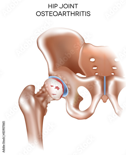 Arthritis of the hip joint