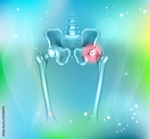 Arthritis of the hip joint