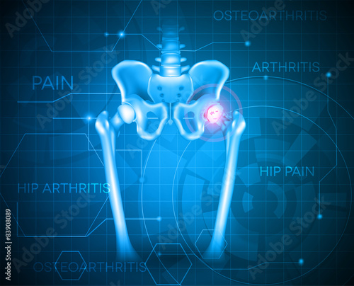 Arthritis of the hip joint