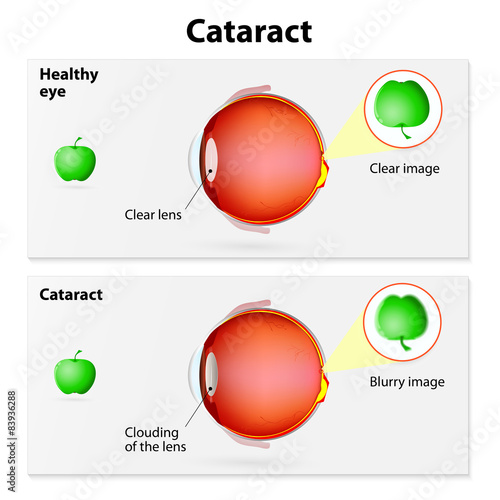 cataract