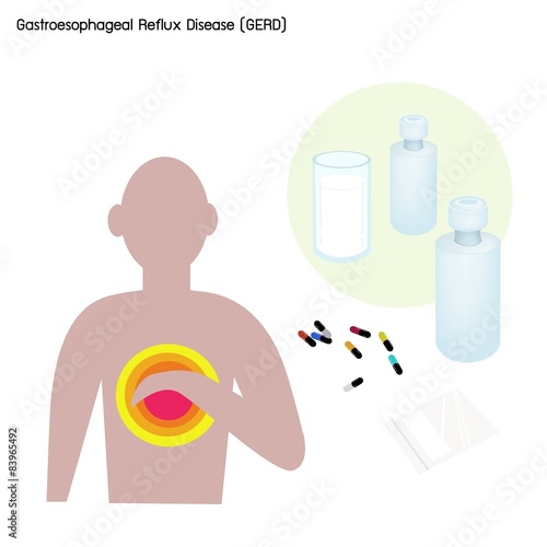 Gastroesophageal Reflux Disease or GERD with Treatment