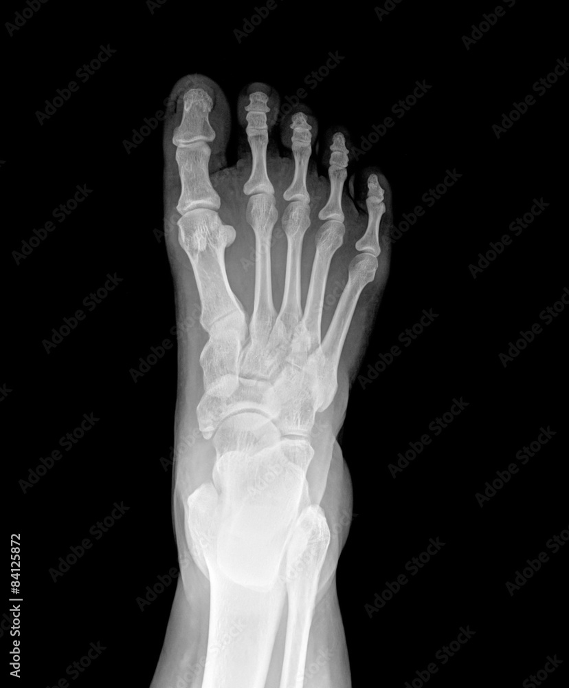 X-ray picture of foot X-ray picture of foot