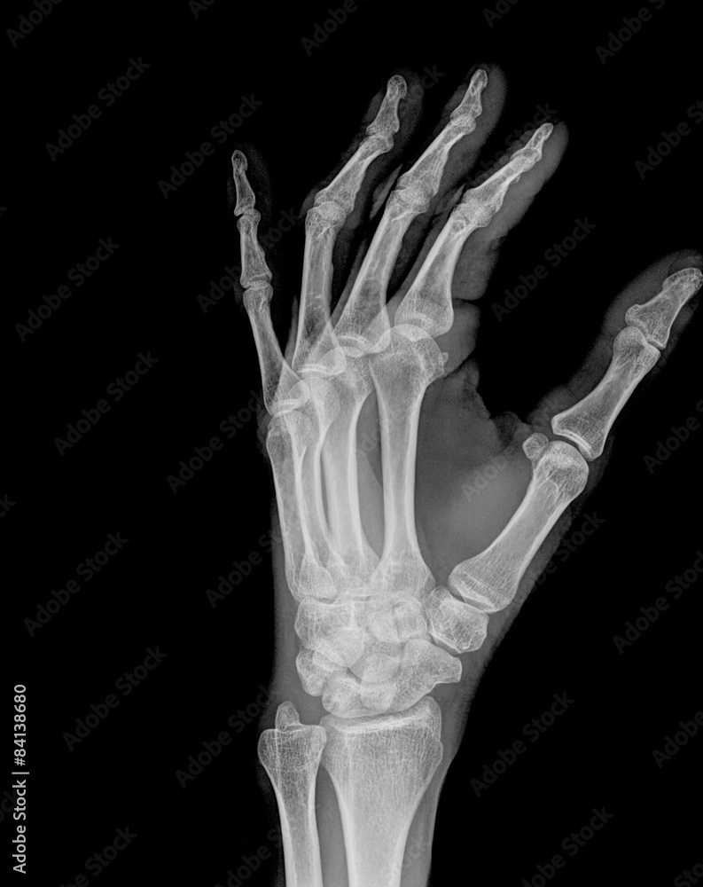 X-ray of both human hand X-ray of both human hand