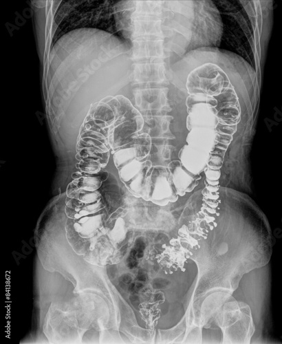 Fotografia upper gastrointestinal (UGI)