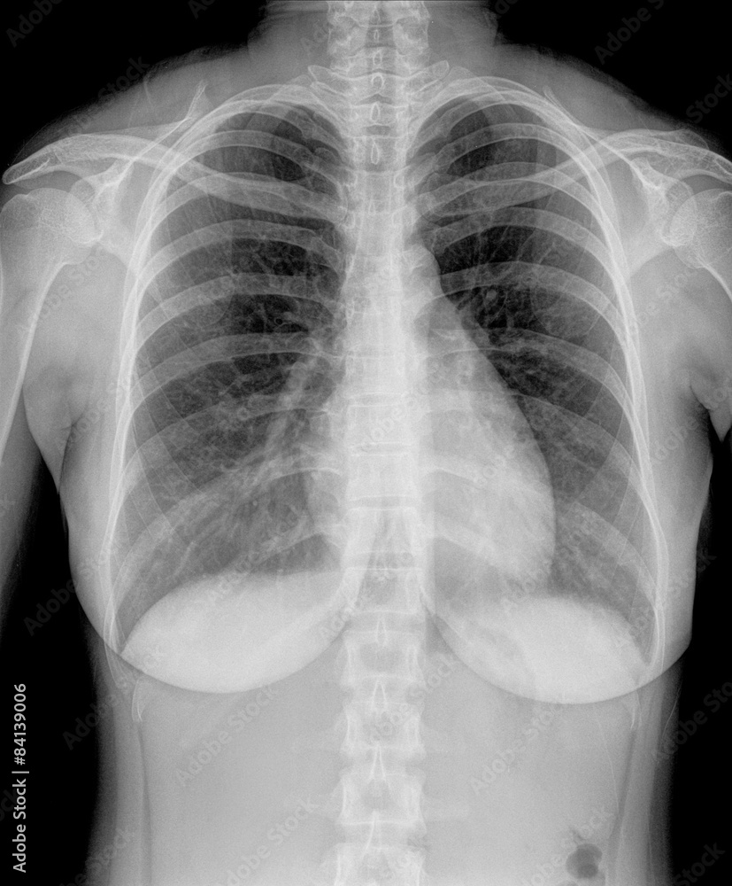 X-Ray Image Of Woman Chest for a medical diagnosis X-Ray Image Of Woman Chest for a medical diagnosis