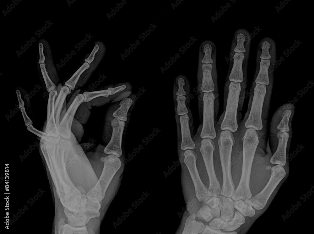 x ray hand x ray hand