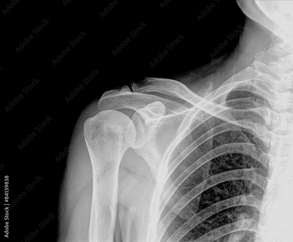 X-ray of Right human shoulder with hold 5 Kg , A C joint X-ray of Right human shoulder with hold 5 Kg , A C joint