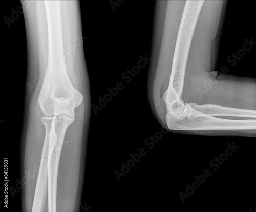 Photography Right elbow radiography. Open and closed position