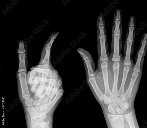 X-ray image of human hand with finger point © thailoei92