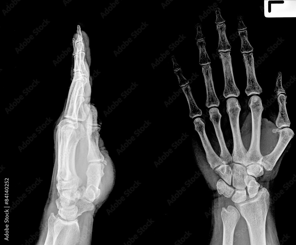 X-ray of both human arms and hands X-ray of both human arms and hands