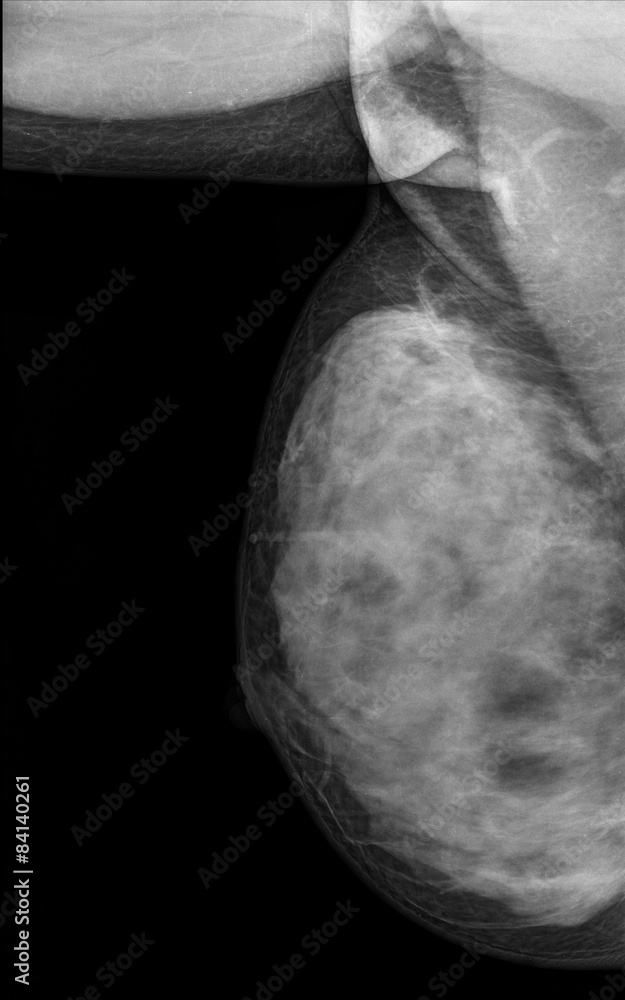 Xray Breast Cancer (Mamary tumor) Stock Photo Adobe Stock