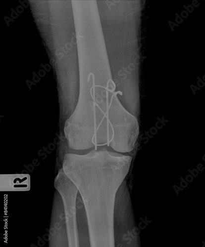 Billede på lærred AP x-ray of injured knee front side