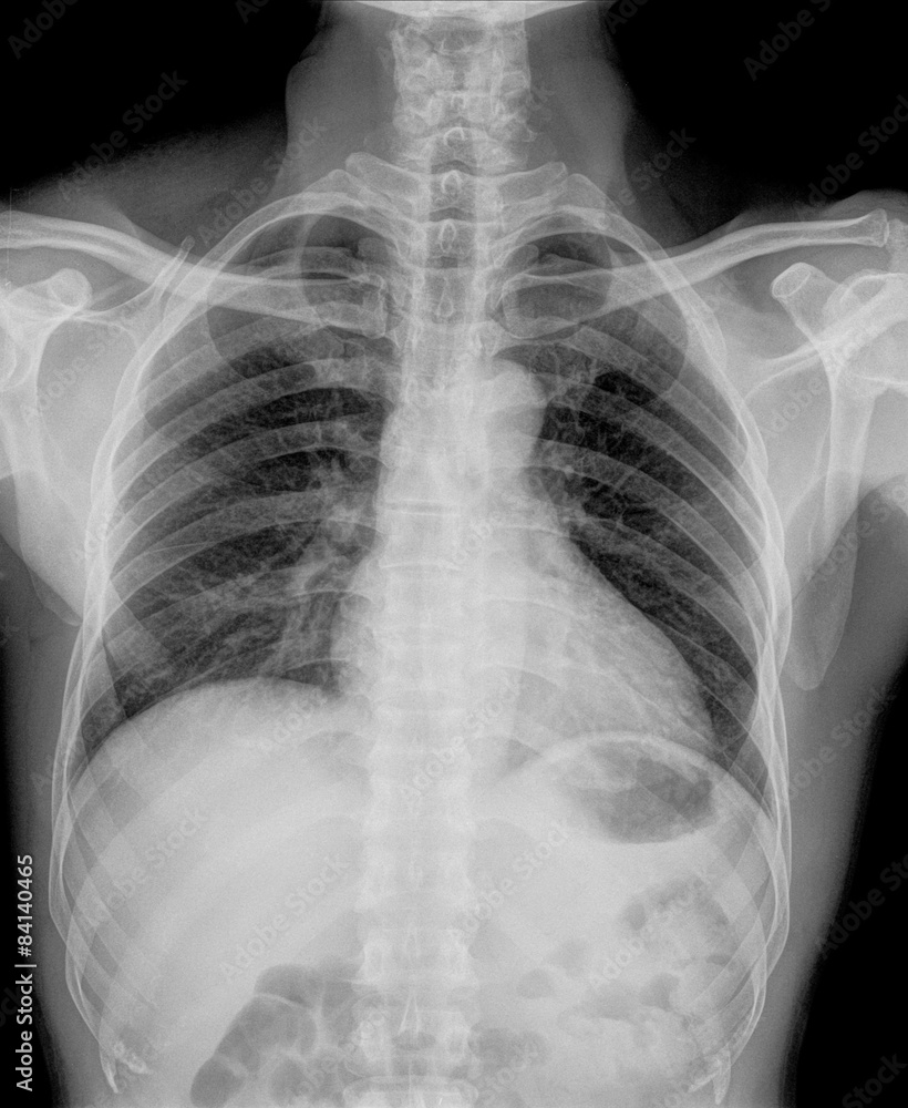 X-Ray Image Of Human Chest for a medical diagnosis X-Ray Image Of Human Chest for a medical diagnosis