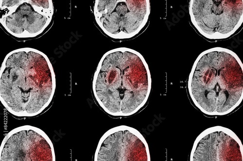 Canvas Print Ischemic stroke : ( CT of brain show cerebral infarction at left frontal - tempo