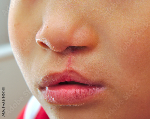 Boy showing a monolateral cleft lip repaired.