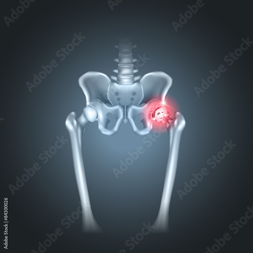 Human pelvis hip pain