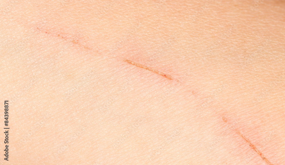 Fototapeta premium a wound on the skin