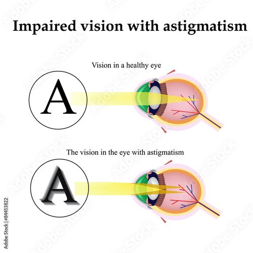 Astigmatism. As the eye can see with astigmatism. Impaired