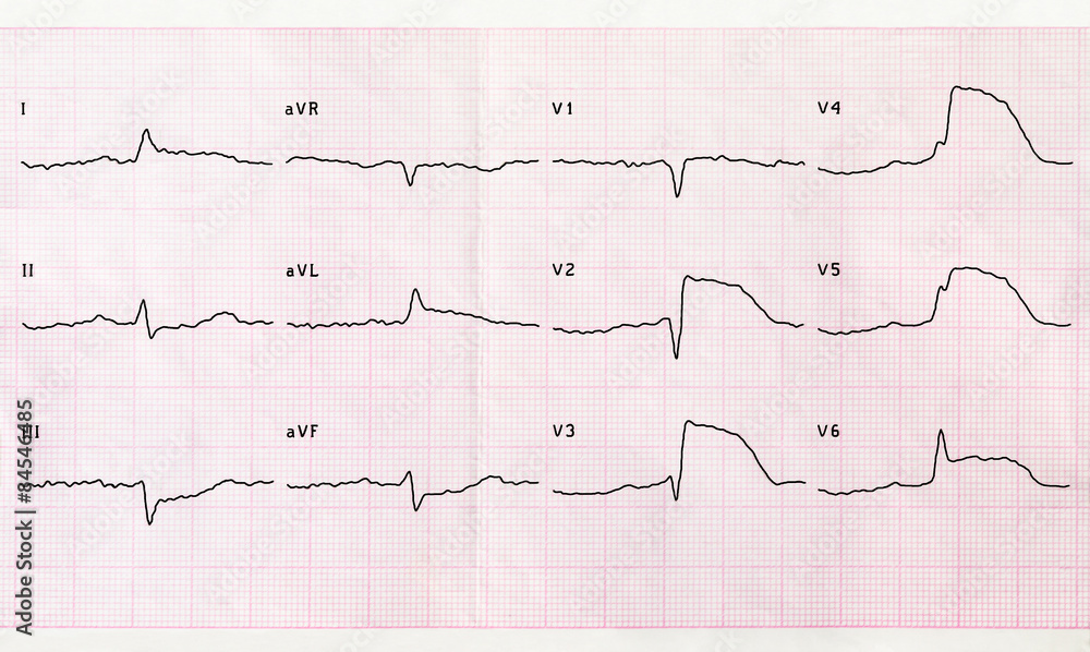 ECG with acute period macrofocal anterior myocardial infarction ECG with acute period macrofocal anterior myocardial infarction