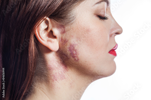 beautiful woman with port-wine stain (birthmark) on her face.
 photo