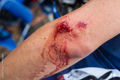 Foto Blessure, sang