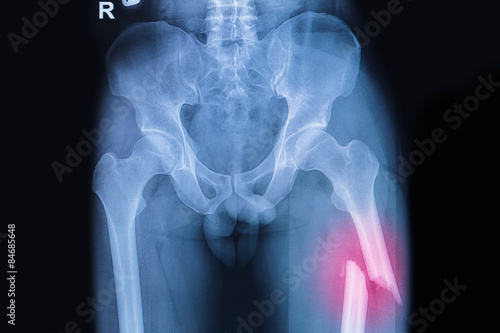 Leinwand Poster Fractured Femur, Broken thigh x-rays image
