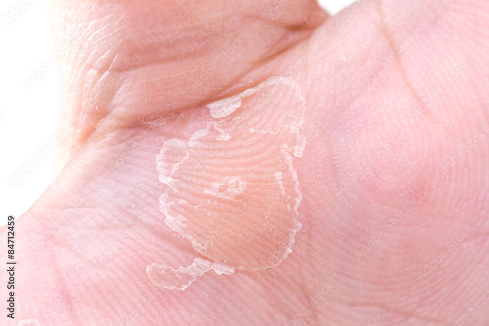 Fototapeta premium Close up peeling on hand