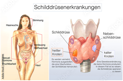 Schilddrüsenknoten-Erkrankungen photo