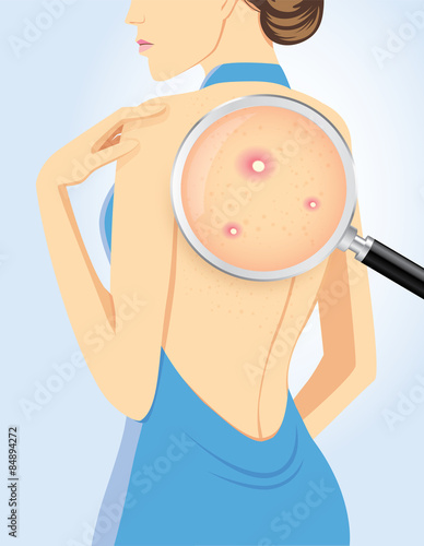 Finding acne on back of beauty women with magnifying glass