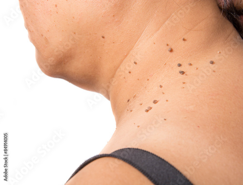 skin of a woman with moles