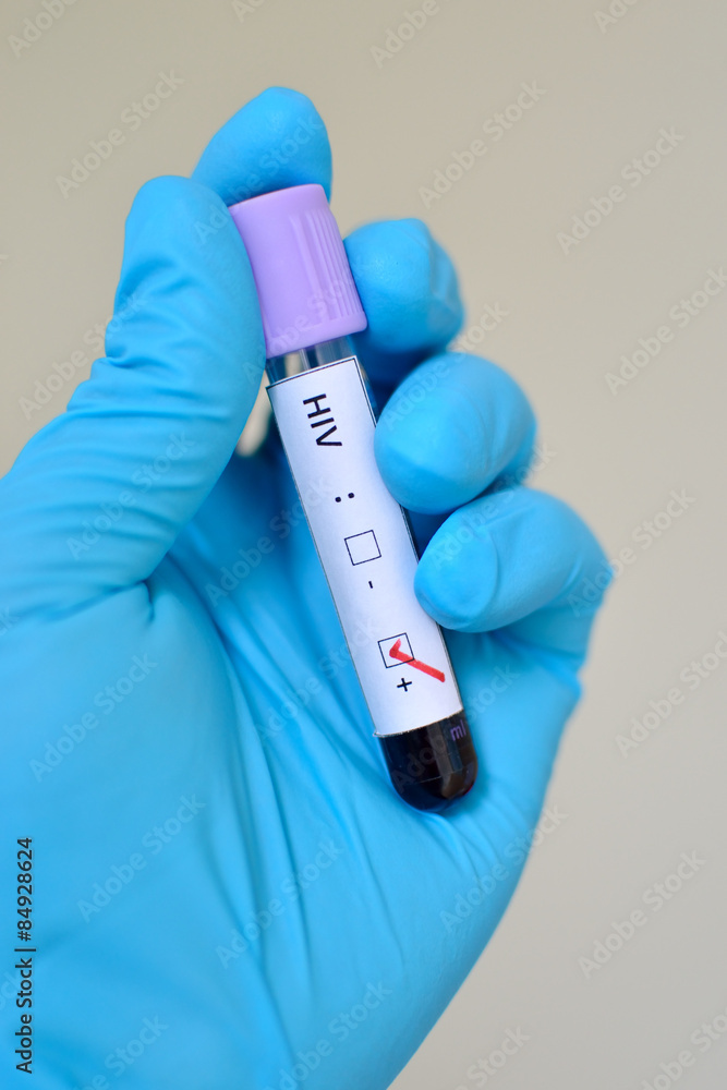 Obraz premium Blood sample with HIV positive