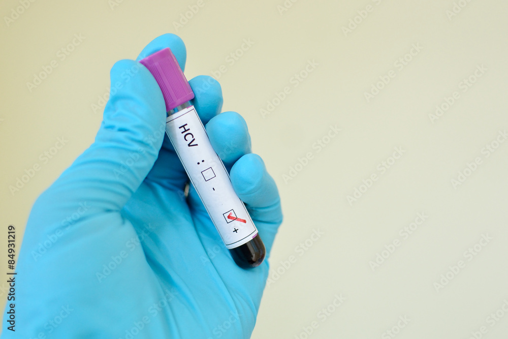 Obraz premium Hepatitis C virus positive