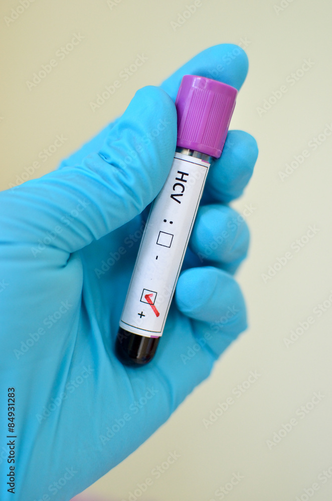 Obraz premium Hepatitis C virus positive